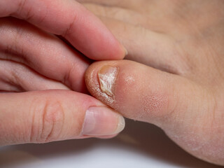 A woman's hand holds the little finger of a foot with problems on the nails. Infection of the feet, cracked. close-up, selective focus