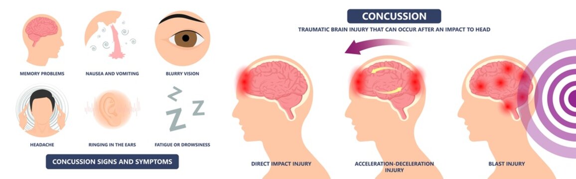Brain Injury mild post head bleed sport loss second bump blow jolt hit skull ear contact hockey trauma fall pain athlete ball  rugby play 