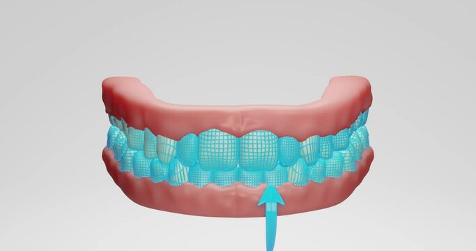 3d animation of neon mesh protection of stylized teeth, mouth, getting rid of yellow plaque, harmful bacteria, tartar, caries development, teeth whitening. bacteria attack tooth enamel