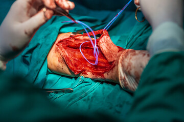 Radial free flap microvascular surgery