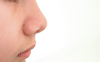close up blackhead pimples on the nose of a teenage boy. Skincare  acne problem in a teenager boy isolated on white background with copy space for texts.