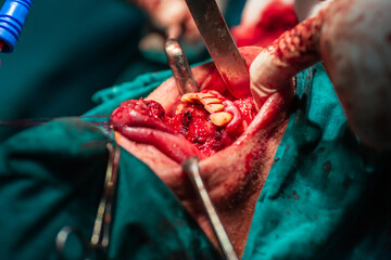 Jaw tumor removal by maxillofacial surgeons in hospital
