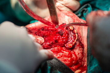Jaw tumor removal by maxillofacial surgeons in hospital
