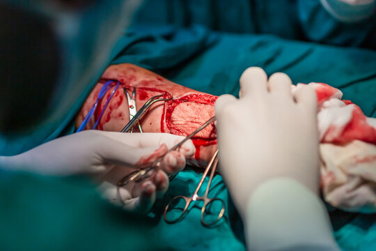 Radial forearm free flap microvascular surgery in hospital
