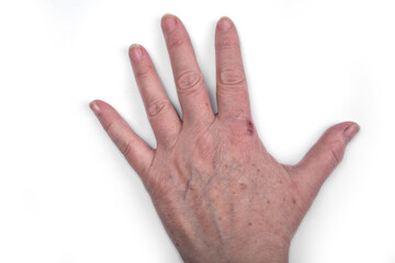 Old female hands with a spots and wound