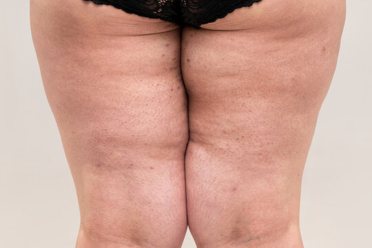 Fat legs with acne on skin, obesity female body