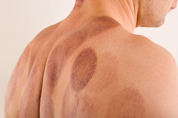 Cupping therapy marks on black