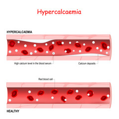 Hypercalcaemia. hypercalcemia is a high calcium level in the blood