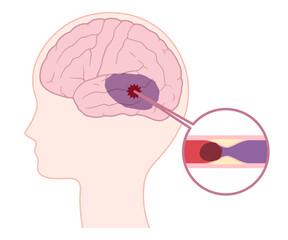 脳血管性認知症の脳のイラスト Wall Mural Wallpaper Murals ふわぷか