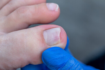Fototapeta premium Sick nail with fungus after treatment. Medical pedicure in the salon.