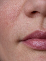 
skin with enlarged pores and rosacea