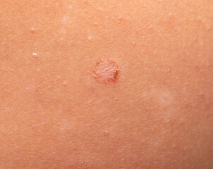 peeling on the skin as a background