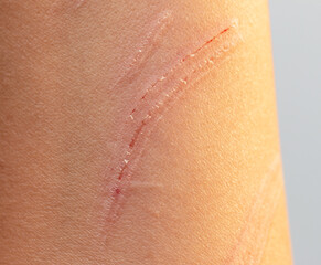 Fototapeta premium scratch on the skin of the hand