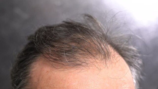 Hair Loss Problem in Old Age Men. Senior is scratching his bald patches with his hands on a gray background. View from above.