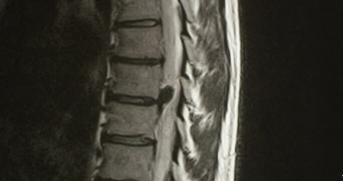 Examining an MRI Scan of Lumbar Spines of a Patient with Chronic Back Pain Showing Degenerative Change of the Lumbar and Sacral Spines with Disc Herniation