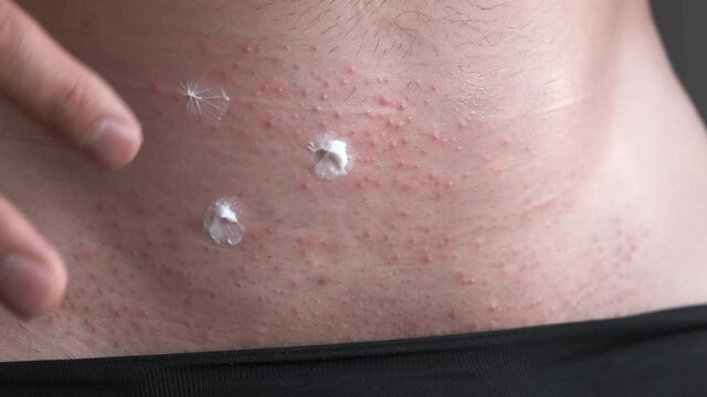Man is applying ointment on itchy skin irritation with red spots, closeup view. Part of body in black pants. The concept of venereal diseases. Allergies, psoriasis, insect bite. Itchy skin irritation.