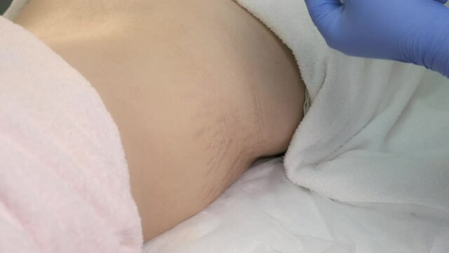 Doctor makes injection of ozone gas in patient abdomen on side on ozone therapy, closeup view. Treatment, cure and remove of skin tags and stretches. Cosmetologist woman in gloves.