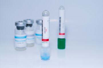 Testing for presence of coronavirus. Tube containing a swab sample that has tested positive for COVID-19. A single bottle vial of Covid-19 coronavirus vaccine in a research medical lab. 