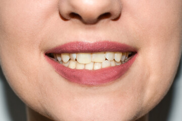 Naklejka premium Close up of young woman's face with crooked teeth. Teeth before install braces. Teeth need ortodonti doctor (dentist) help. 