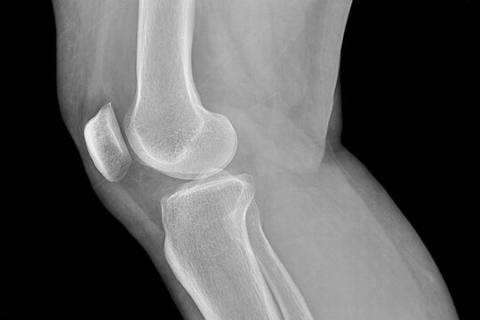 Knee radiography of a hospital patient