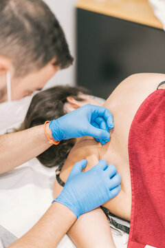 Closeup of crop anonymous therapist inserting needles in back of patient and helping relieving pain with acupuncture method