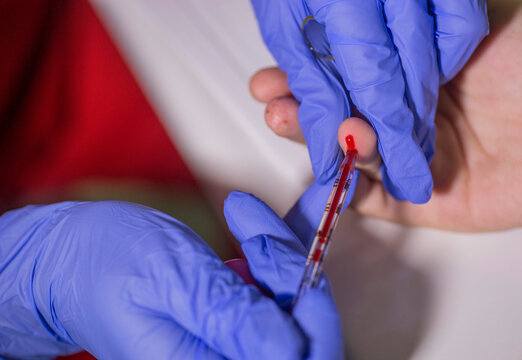 Doctor takes blood sample from a patient's finger using a capillary tube