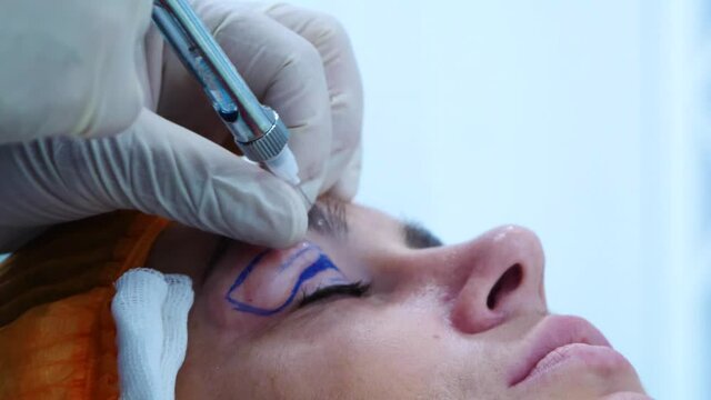 Upper blepharoplasty. The surgeon puts an injection in the eye. Surgical eye marking. Plastic surgery. Transconjunctival blepharoplasty. Eye surgery. Surgery.