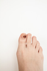 Bruising under the fingernail of the big toe