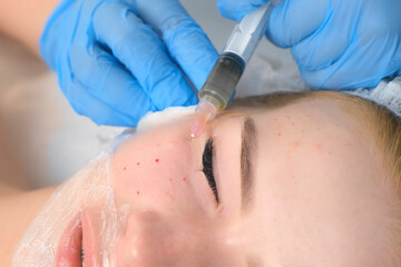 PRP therapy in beauty clinic. Cosmetologist doing injections of blood plasma to womans face to cure problem skin, closeup top view. Treatment of skin in cosmetology for young female.