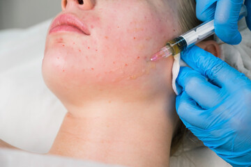 PRP therapy in beauty clinic. Cosmetologist is doing injections of blood plasma to womans face to...