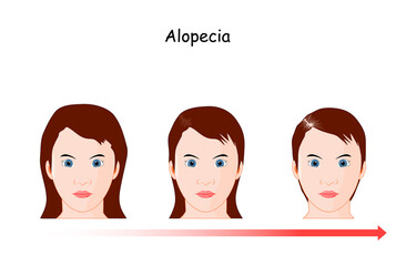 Female alopecia development