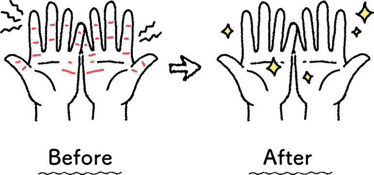 あかぎれがスキンケアで綺麗になった手のイラスト　ビフォーアフター Illustration of a hand with chapped skin that has been cleaned up with skin care before and after
