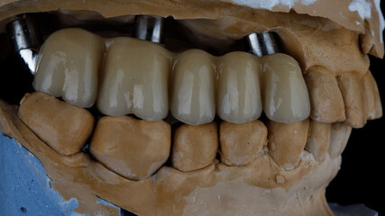 dental bridge for five chewing teeth, installed on the model in the bite