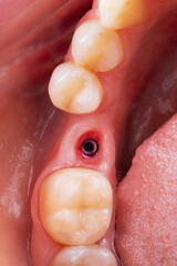 Obraz premium the gum cavity with the installed dental implant