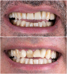 before and after picture for dental treatment by zirkon bridge