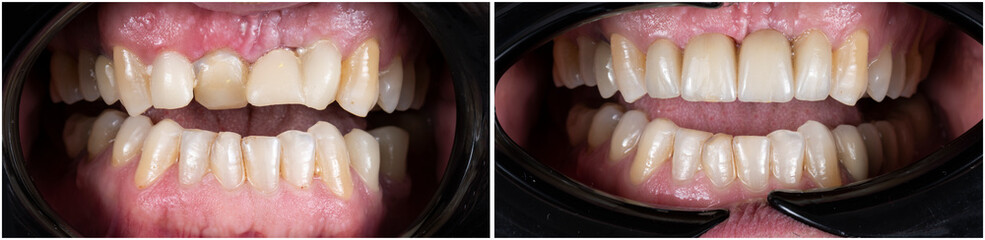 before and after picture for dental treatment by zirkon bridge