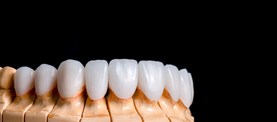 press ceramic veneers and crowns