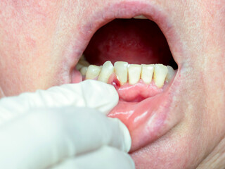 Obraz premium On the gum, an abscess formed, a tumor with purulent contents. Dentist examination.