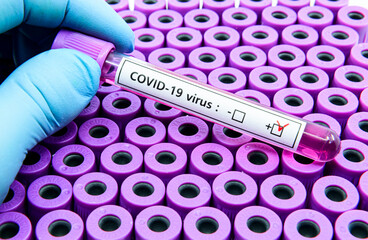 A researcher detect COVID-19 positive patients by blood sample. The blood sample of COVID-19...