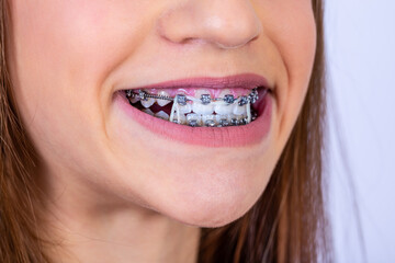 Close up portrait of a happy teen girl with braces and beautiful smile on white background