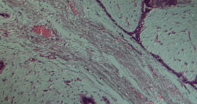 Fibroadenoma tissue under the microscope 100x