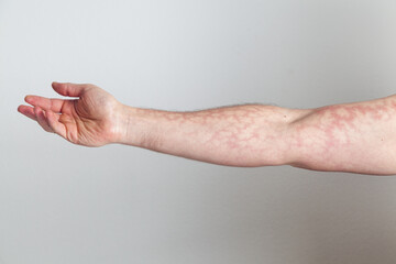 Male upright arm with red skin capillary network