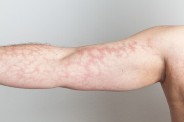 Closeup of male upright arm with red skin capillary network