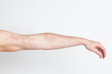 Male upright left arm with red skin capillary network