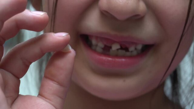 A girl showing her freshly fallen middle incisor tooth between her fingers