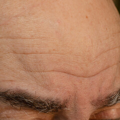 Pronounced wrinkles on the forehead of man.