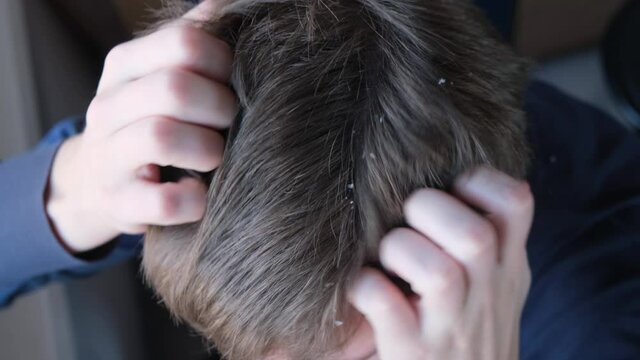 Dandruff on the head. A man scratches his head with his hands, close-up