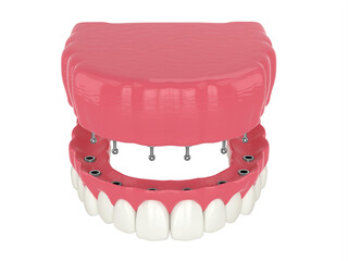 3d render of removable snap-on full implant denture installation