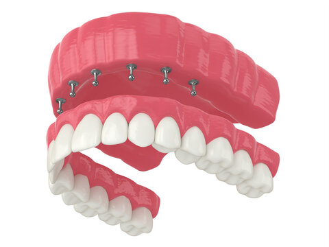 3d render of removable snap-on full implant denture installation