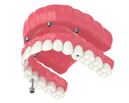 3d render of all on 4 dental implants treatment